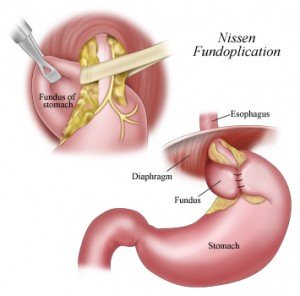 Nissen-fundoplication