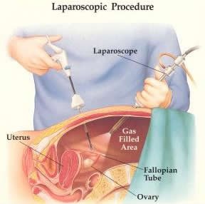 laporoscopy